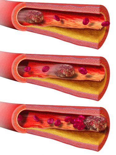 Atherosclerosis treatment in Lafayette LA - blood clot thrombosis example